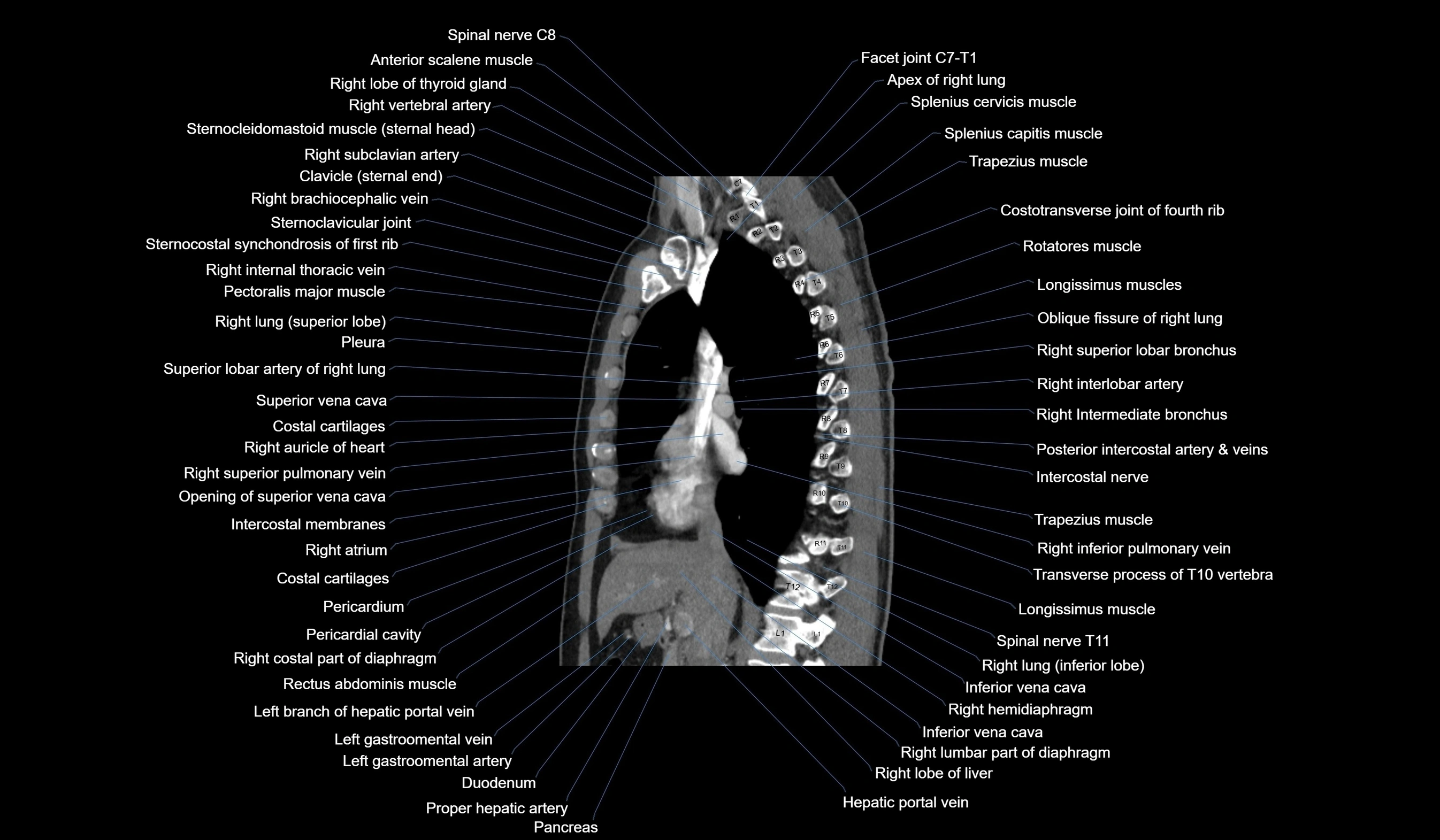 CT chest (thorax) labelled sagittal cross sectional anatomy radiology image-00063.webp
